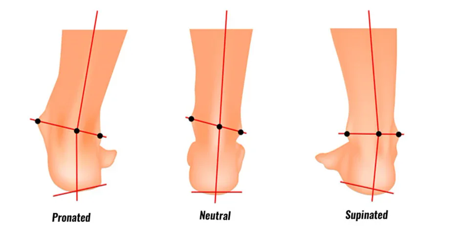 Heels seen from behind: pronated, rolling inwards; neutral; and supinated, rolling outwards