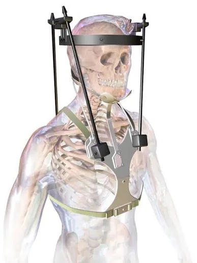 A halo brace