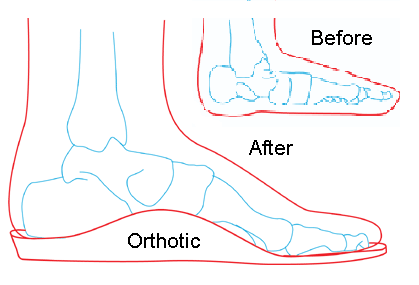 foot-orthotics